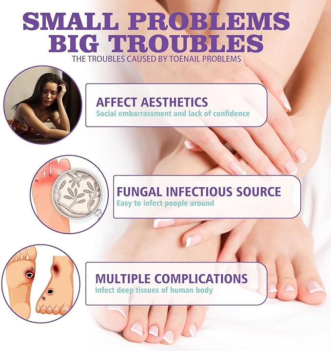 بخاخ مضاد لفطريات الأظافر 